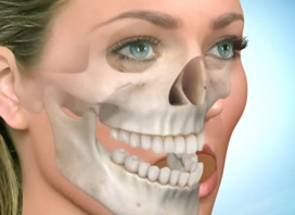 Upper Jaw Advancement Surgery